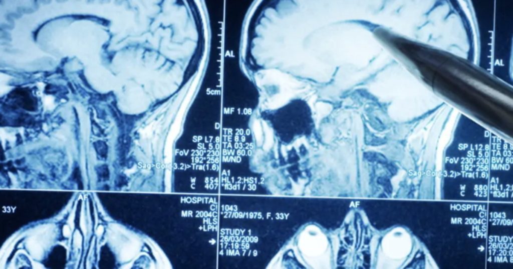 A brain tumor heals but... an inexplicable transformation - Libero Quotidiano