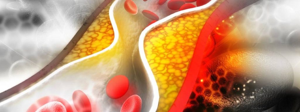 Cholesterol, the first sign when it's too high: What you need to know